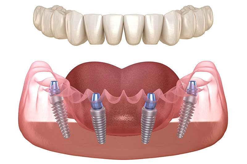 All-on-4-dental-implants-