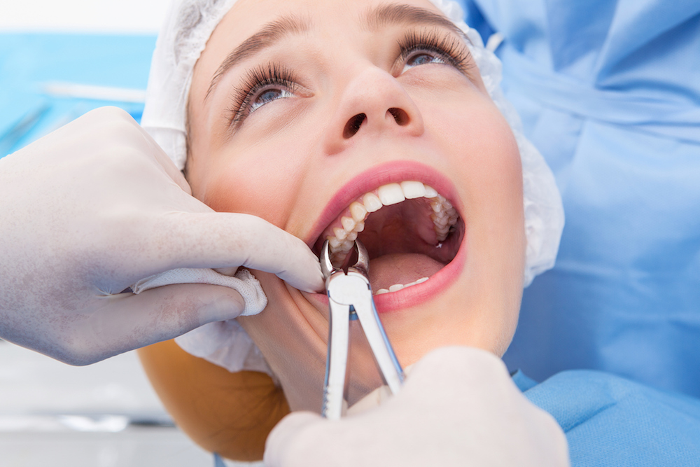 Young woman having tooth removed. Close up picture of a woman mouth with a dentist hand holding extraction forceps (Young woman having tooth removed. Close up picture of a woman mouth with a dentist hand holding extraction forceps, ASCII, 115 componen