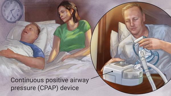 SLEEP APNEA CPAP DEVICE